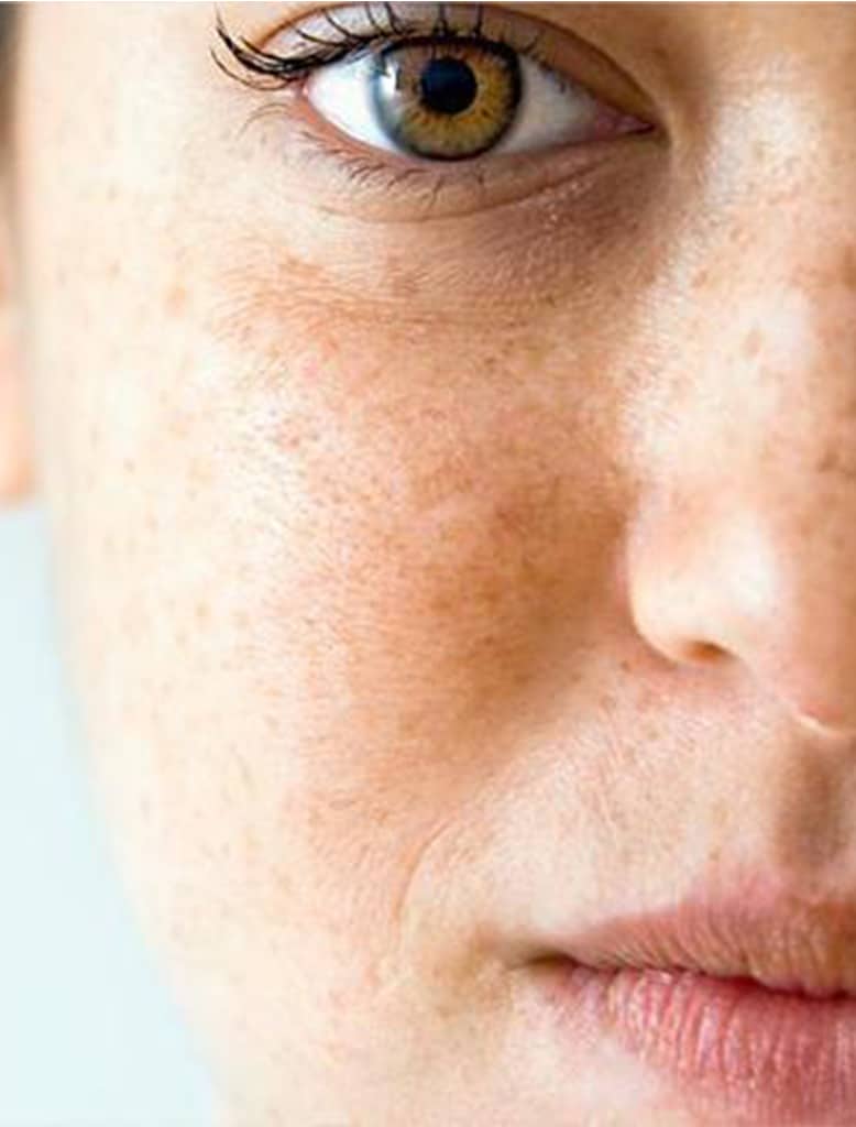 HOW TO TREAT DARK SPOTS & DISCOLOURATION