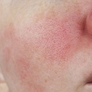 Reactive Skin in Summer: Why Heat Makes Sensitivity Worse
