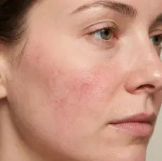 Redness and Sensitivity: Why Your Skin Barrier Is the Root Cause