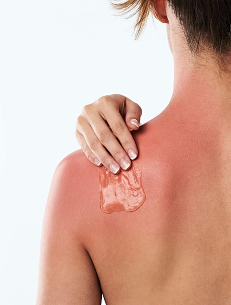 What are the true benefits of after sun care?