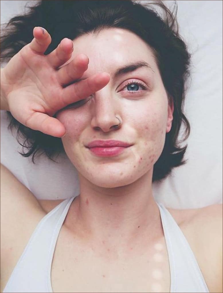 Can I get rid of my acne scarring?