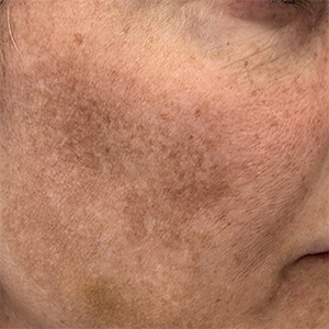 Melasma vs Hyperpigmentation: What Is the Difference and How Do You Treat Each
