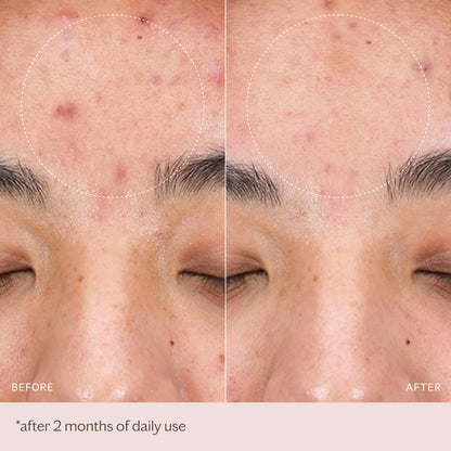 LightMax SuperCharged LED 2.0 Mask