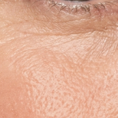 Fine lines & Wrinkles