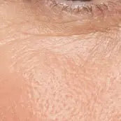 Fine lines & Wrinkles