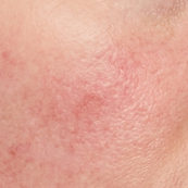 Redness & Sensitivity