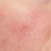 Redness & Sensitivity