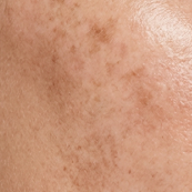 Dark Spots & Pigmentation