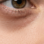 Puffiness & Dark Circles