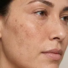 Dark Spots & Pigmentation