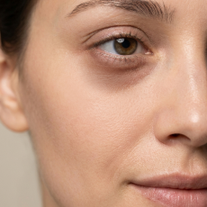 Puffiness & Dark Circles
